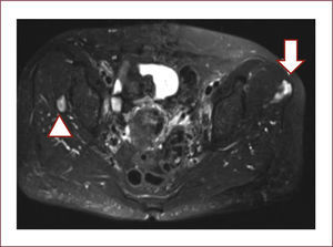 CORTE AXIAL DE SECUENCIA DE RM POTENCIADA EN T2 CON SUPRESIÓN GRASA. Se identifican los dos nódulos hiperintensos de 3x2cm en el glúteo menor derecho (cabeza de flecha) y otro de 6x3cm en el glúteo medio izquierdo sugestivos de metástasis.