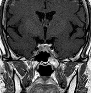 RM DE SILLA TURCA EN SECUENCIA T1 POST GADOLINIO Se observa la lesión hipocaptante lateralizada a derecha que corresponde a pequeño microadenoma de hipófisis.