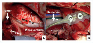 FOTOS INTRA OPERATORIAS DE PACIENTE DE FIGURA 1 A) Post-resección de neocorteza del polo temporal derecho. Tumor (flecha) en porción anterior de la amígdala e hipocampo. B) Electrocorticografía final en corteza temporal lateral posterior, post resección de ganglioglioma + tejido epileptógeno (amígdala e hipocampo).