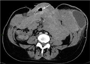 MUJER DE 43 AÑOS CON ANTECEDENTE DE SÍNDROME DE GARDNER (POLIPOSIS ADENOMATOSA FAMILIAR ASOCIADO A TUMORES DE PARTES BLANDAS) Corte axial de TC que muestra conglomerados de masas mesentéricas y de la pared abdominal compatibles con tumores desmoides, con pre-sencia de una fístula (flecha) y una colección en flanco izquierdo.