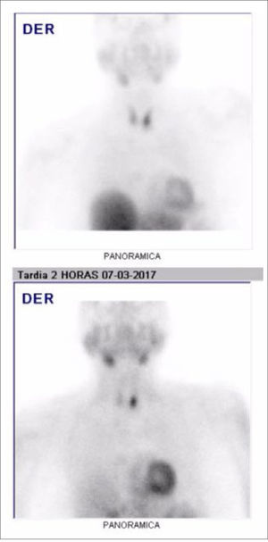 CINTIGRAMA DE PARATIROIDES CON SESTAMIBI-TC99M (A) Imagen precoz que muestra captación difusa en tiroides algo más marcada en lóbulo derecho. (B) Imagen tardía de 2 horas post inyección muestra retención focal en polo inferior derecho que corresponde a adenoma paratiroideo.