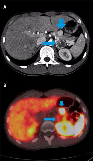 PET/CT CON GA68-DOTATATE (ANÁLOGO DE SOMATOSTATINA) EN PACIENTE JOVEN CON SOSPECHA DE FEOCROMOCITOMA (A) CT con fase arterial muestra gran lesión necrótica en suprarrenal derecha (flecha larga) y nódulo hipervascular en cuerpo pancreático (flecha corta). (B) El estudio fusionado demuestra intensa sobre-expresión de receptores de Somatostatina en lesión pancreática (flecha corta) y captación en la periferia de la lesión suprarrenal (flecha larga) atribuible a necrosis central.
