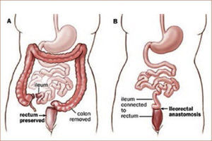 COLECTOMÍA TOTAL CON ILEO RECTO ANASTOMOSIS http://chelseasupdate.blogspot.de/2013/04/total-colectomy-with-ilecorectal.html
