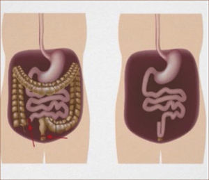 PROCTOCOLECTOMÍA CON RESERVORIO ILEAL http://fundeccu.com.ar/informacion-para-pacientes/cirugia-en-eii-generalidades/