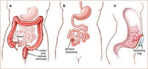 PROCTOCOLECTOMÍA CON ILEOSTOMÍA TERMINAL https://www.jhmicall.org/GDL_Disease.aspx?CurrentUDV=31&GDL_Cat_ID=AF793A59-B736-42CB-9E1F-E79D2B9FC358&GDL_Disease_ID=5F8BA0A9-ACCC-43B8-9815-7976ABA08EE2