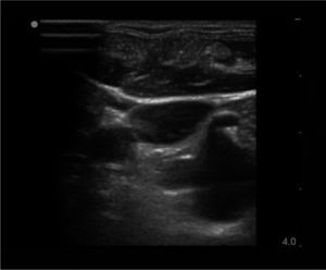 IMAGEN DE ULTRASONIDO DE LA VENA YUGULAR INFERIOR EN LA SECCIÓN BAJA DEL CUELLO Se puede apreciar la gran cercanía de la arteria subclavia (y su rama de tronco tirocervical) el que se encuentra detrás muy próximo y vulnerable a daño por traspaso de la aguja en la vena.