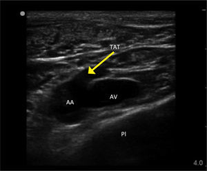 IMAGEN DE ULTRASONIDO DE LA VENA AXILAR DERECHA EN HOMBRE SALUDABLE Se aprecia la vena axilar (VA), arteria axilar (AA) y gran tronco toracoacromial en cercanía a la arteria axial (TAT), pared torácica y pleura (PL).