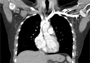 TOMOGRAFÍA COMPUTARIZADA CORONAL DEL TÓRAX QUE MUESTRA LA CERCANÍA DE LA VENA CAVA SUPERIOR CON LA PLEURA Y LA ASCENDENTE AORTA