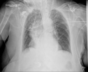 Un catéter de diálisis ha sido insertado desde la vena yugular interna izquierda siendo demasiado corto y rozando la pared de la vena cava superior, con riesgo de perforación y trombosis. El paciente tiene una hernia al hiato de gran tamaño.