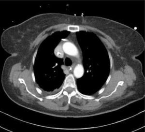 IMAGEN DE TOMOGRAFÍA COMPUTARIZADA Un catéter fue retirado 3cm, pero aun así se lo ve rozando la pared de la vena innominada.