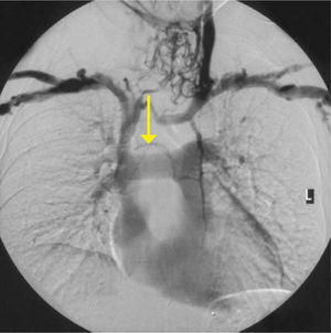 UN PACIENTE SIENDO INYECTADO CON MEDIO DE CONTRASTE EN AMBOS BRAZOS SIMULTÁNEAMENTE Oclusión de la vena innominada izquierda (flecha) con flujo colateral alrededor del área de la tiroides y dentro del tórax.