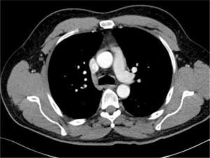 TOMOGRAFÍA COMPUTARIZADA AXIAL DEL TÓRAX Se muestra cómo los vasos sanguíneos mamarios, pleura medial a la derecha, vena cava superior, aorta ascendente, y vena ácigos son todas similares en el primer y segundo plano. Los catéteres en cada una de estas diferentes estructuras no se distinguen claramente en el plano de la imagen (Radiografía de tórax).