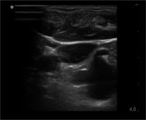 AN ULTRASOUND IMAGE OF RIGHT IJV LOW IN THE NECK Note the close proximity of the subclavian artery (and its branch the thyrocervical trunk) which is close behind and vulnerable to damage from needle transfixion of the vein.