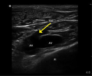 AN ULTRASOUND IMAGE OF RIGHT AXILLARY VEIN IN MUSCULAR MALE Note Axillary vein (AV), axillary artery (AA), large thoracoacromial trunk off axillary artery (TAT), chest wall and pleura (Pl).