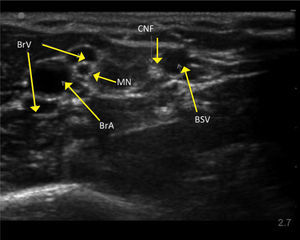 US IMAGES OF RIGHT UPPER ARM VESSELS UPPER ARM SEEN FROM BELOW Brachial artery (BrA), Brachial veins (BrV), Basilic vein (BsV), Median nerve MN, cutaneous nerves forearm (CNF).