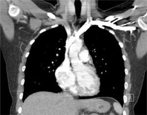 CORONAL CT OF CHEST SHOWING CLOSE PROXIMITY OF SVC TO PLEURA AND ASCENDING AORTA.