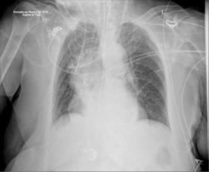 a. A dialysis catheter has been inserted from the left IJV and is too short with catheter abuttting SVC wall, with risks of perforation and thrombosis. The patient has large hiatus hernia.