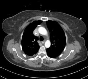 INSET CT IMAGE. Catheter was pulled back 3cm but was still seen to be abutting side wall of innominate vein.