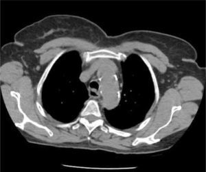AXIAL CT OF CHEST SHOWING THE LEFT INNOMINATE VEIN CURVING ANTERIORLY TO ADD FURTHER CORNERS FOR LEFT SIDED CATHETER TO PASS THROUGH TO ACCESS THE SVC This patient had distorted aortic arch from aneurysm but this curvature is seen without obvious disease. It is a common reason for difficulty in positioning left sided catheters.