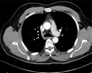 AXIAL CT O CHEST This shows how the internal mammary vessels, medial pleura on right, SVC. ascending aorta, and azygous vein are all similar in anterior to posterior plane. Catheters in these different structures cannot be dintinguished on one plane imaging (CXR).