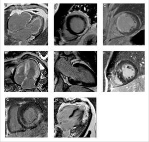 Patrones de realce tardío con gadolinio (RTG) en diversas miocardopatías (A) Pacientes con endomiocardiofibrosis con RTG subendocardico difuso con compromiso del ventrículo derecho e izquierdo. Observe la obliteración de la región apical del ventrículo derecho. (B) RTG con patrón subepicárdico característico de miocarditis. (C) RTG con patrón subendocárdico y transmural compatible con infarto de miocardio. (D) RTG con patrón subendocárdico difuso y con compromiso del ventrículo derecho y ambas aurículas. Se observa anulación del pool sanguíneo con una imagen gris oscura de las cavidades cardiacas. Los hallazgos son compatibles con amiloidosis cardiaca. (E) RTG con patrón focal intramiocárdico relacionado con sarcoidosis. (F) RTG con patrón intramiocárdico relacionado a miocardiopatía hipertrófica septal asimétrica obstructiva. (G) RTG con patrón intramiocárdico a predominio del segmento inferolateral basal característico de la enfermedad de Fabry. (H) Aneurisma apical con RTG transmural en paciente con enfermedad de Chagas. Ref. 1.