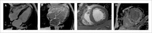Paciente con amiloidosis Imagen de cine de cinerresonancia en vista 4 cámaras y eje corto a nivel medial donde se observa un incremento difuso de los espesores (a, b). Respectivas imágenes de RTG (c, d) donde se observa realce de gadolinio subendocardico (flechas en d) con anulación del pool sanguíneo hallazgos característicos de la amiloidosis cardíaca.