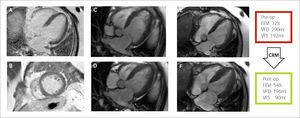 Estudio de viabilidad Imágenes de RTG en vista de 4 cámaras (A) y eje corto (B) a nivel basal donde se observa un miocardio negro, viable, sin signos de infarto de miocardio previo. Imágenes de cinerresonancia previo a la cirugía en vista de cuatro cámaras en fin de diástole (C) y fin de sístole (D). Imágenes de cinerresonancia posterior a la cirugía en vista de cuatro cámaras en fin de diástole (E) y fin de sístole (F). Se observa una mejor motilidad global y reducción de los volúmenes respecto a la RMC previa a la cirugía de revascularización. CRM = Cirugía de revascularización miocárdica, FEVI = Fracción de eyección del ventrículo izquierdo, Post-op=postoperatorio, Pre-op= preoperatorio, VFD= volumen de fin de diástole del ventrículo izquierdo, VFS = volumen de fin de sístole del ventrículo izquierdo.
