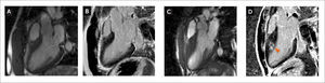 Evaluación de miocardiopatías hipertróficas A) Imágenes de cinerresonancia en 3 cámaras donde se observa hipertrofia del septum basal (segmento anteroseptal 16mm). B) Imagen en 3 cámaras de RTG donde no presenta realce en las imágenes RTG. C) Imágenes de cinerresonancia en 3 cámaras donde se observa hipertrofia del septum basal (segmento anteroseptal 27mm). D) Imagen en 3 cámaras de RTG donde presenta realce con patrón focal intramiocárdico en las imágenes RTG (flecha naranja).