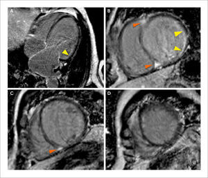 Evaluación de re-sincronizador (A) Imágenes de RTG en vista de 4 cámaras en las que se observa un ventrículo izquierdo mayormente sin fibrosis focal (miocardio negro) con un área de RTG subendocardica no transmural en el segmento anterolateral basal (flecha amarilla). (B) (C) (D) Imágenes de RTG en eje corto a nivel basal, medial y apical respectivamente con RTG subendocardico en el segmento anterolateral basal e inferolateral basal (flechas blancas) y RTG focal intramiocarico en el septum basal y medial (flechas naranjas). Si bien hay RTG, el patrón es subendocárdico y no trasmural lo pronostica una respuesta favorable con la resincronización.