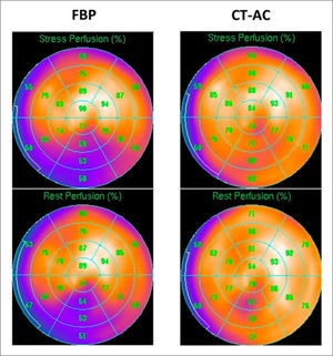 Mapa polar de perfusión en estrés (Fila superior) reposo (Fila inferior) (Fila superior) reposo (fila inferior) que muestra un artefacto por atenuación diagragmática de la pared inferior al ser reconstruido con retroproyección filtrada (FBP) y que desaparece al utilizar el mapa de corrección de atenuación del CT (CT-AC). Ref. 6.