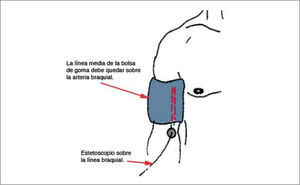 Colocación del manguito