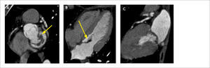 Válvula Mitral Mixomatosa (A) MPR en eje corto en región basal (B) MPR en eje corto en cuatro cámaras, que muestra válvula mitral engrosada mixomatosa (flechas). (C) MPR en dos cámaras en sístole que muestra prolapso de la válvula mitral.