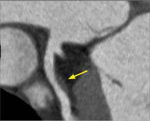 Placa de Ateroma MPR curva de arteria descendente anterior que muestra placa no calcificada, con remodelamiento positivo, de densidad lipídica, que determina estenosis menor a 40%. Corresponde a una placa vulnerable, que puede causar un síndrome coronario agudo.