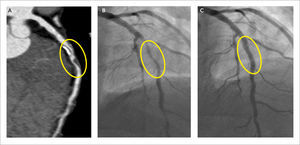 Placas de Ateroma (A) MPR curva de arteria descendente anterior que muestra placa mixta y placa no calcificada que determinan disminución de calibre mayor a 70%. (B) Coronariografía que confirma las lesiones. (C) Control post angioplastía.