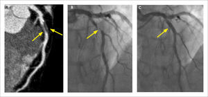 Placas de Ateroma (A) MPR curva de arteria descendente anterior que muestra placa mixta con gran componente lipídico que determina estenosis mayor a 70%. (B) Coronariografía que confirma la lesión. (C) Control post angioplastía.
