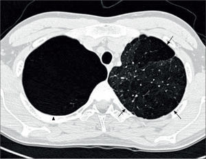 CT thorax of a 20 year old with a history of BPD The arrows indicate emphysematous changes in the left lung field, while the arrowhead shows a large right upper lohe bulla. Reprinted with permission (51).