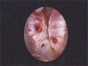 Image of urethral bulking post injection. Good coaptation of urethral walls seen