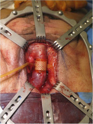 The artificial sphincter cuff placed around the bulbar urethra