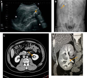 Imágenes utilizadas en el diagnóstico de litiasis urinaria A) Ultrasonido: Litiasis renal con sombra acústica. La flecha muestra litiasis renal. B) Radiografía renal y vesical simple. La flecha muestra litiasis renal radiopaca. C) Tomografía Axial Computarizada Abdominal sin medio de contraste. La flecha muestra una litiasis en pelvis renal izquierda. D) “UROTAC” que muestra fase tardía con eliminación de medio de contraste en vía urinaria alta (Flecha)