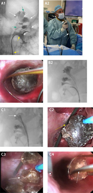 Nefrolitectomia endoscópica retrógrada flexible (NERF) A1. Radiografia intraoperatoria: Sistema pielocalicilicar contrastado (Pielografía ascendente, flechas blancas), con Guía de seguridad (Flechas verdes) y ureteroscopio deflectado en caliz inferior donde se realiza la fragmentación de la litiasis (flechas amarillas). A2. Cirujano con ureteroscopio flexible digital (flechas blancas), realizando una Nefrolitectomia endoscópica retrógrada flexible digital. B1. Imagen endoscópica de canastillo de nitinol tomando litiasis de caliz inferior de 1cm de diámetro para reposicionar en caliz superior. B2. Imagen radioscópica de canastillo de nitinol tomando litiasis de caliz inferior de 1cm de diámetro para reposicionar en caliz superior. C1. Imagen radiosacópica de reposicionamiento de litiasis en polo superior (flecha blanca) para fragmentación con Laser holmium. C2.Laser holmium (flecha blanca) y litiasis previa a fragmentación (Flecha amarilla). C3. Fragmentos de litiasis (flechas blancas). C4. Retiro de fragmentos con canastillo (flecha blanca).