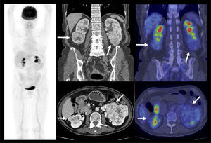 Paciente con múltiples carcinomas de células renales (flechas) bilaterales, con baja captación de F18-FDG.