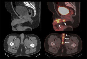 Carcinoma de uretra, con extenso compromiso de uretra peneana, que muestra alta captación de F18-FDG. El paciente no presentó compromiso ganglionar ni a distancia.