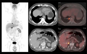 Paciente operado de cáncer renal derecho hace 5 años, con oligometástasis tardías pulmonar y suprarrenal derechas, hipercaptantes de F18-FDG.