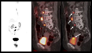 Cáncer vesical de alto grado, con lesión primaria ávida de F18-FDG, visible sólo si se ventanea imagen de PET (flecha larga). Múltiples pequeñas adenopatías metastásicas retroperitoneales (flechas cortas).