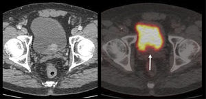 Lesión maligna vesical de baja captación, que se aprecia como un defecto de contraste.