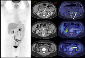 Carcinoma de células transicionales en pelvis renal izquierda (flecha larga), obscurecido por el contenido urinario. Pequeñas adenopatías retroperitoneales (flechas cortas) hipercaptantes, que resultan negativas en la Tomografía Computada (< 10 mm).