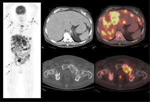 Carcinoma urotelial metastásico. Extenso compromiso metastásico óseo, hepático y peritoneal. Nótese las múltiples localizaciones secundarias en huesos largos en la imagen de MIP (flechas).