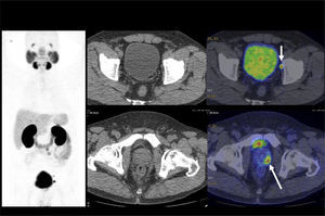 Carcinoma de próstata en etapificación. APE:11 ng/ml. Lesión primaria hipercaptante de Ga68-PSMA en la periferia de la próstata (flecha larga). Pequeña adenopatía obturatriz izquierda hipercaptante (flecha corta), no pesquizable a la tomografía computada.