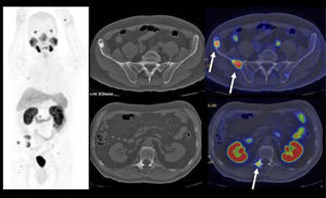PET/CT Ga68-PSMA en paciente con cáncer de próstata operado, con metástasis óseas hipercaptantes, que se traducen en lesiones escleróticas a la tomografía computada.