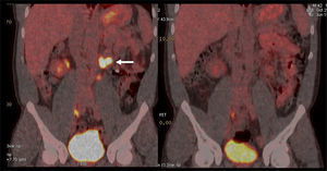 PET/CT F18-FDG de paciente con cáncer testicular izquierdo, con compromiso ganglionar retroperitoneal ávido de F18-FDG (flecha). La imagen de la derecha muestra respuesta completa al tratamiento, con desaparición de las lesiones.